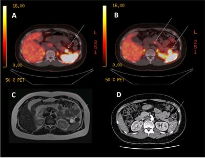 The Impact of 68Gallium DOTA PET/CT in Managing Patients With Sporadic and Familial Pancreatic Neuroendocrine Tumours